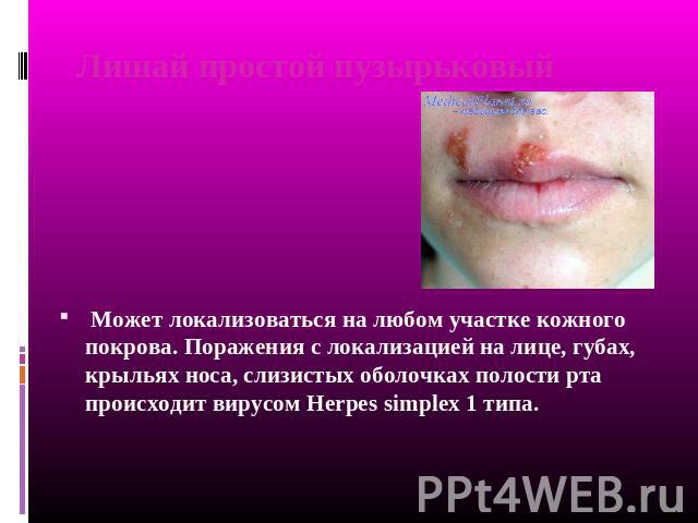 Лишай простой пузырьковый Может локализоваться на любом участке кожного покрова. Поражения с локализацией на лице, губах, крыльях носа, слизистых оболочках полости рта происходит вирусом Herpes simplex 1 типа.